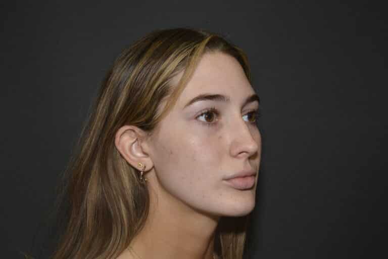 Before Image: FIller to Nose – Liquid rhinoplasty - 
