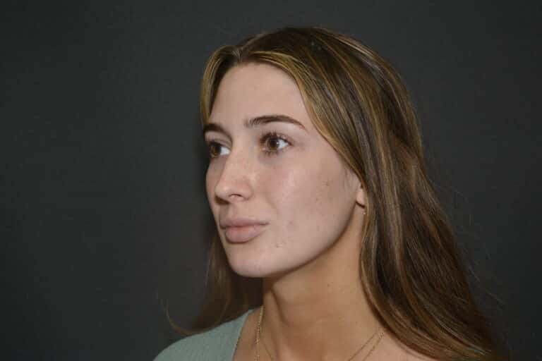 Before Image: FIller to Nose – Liquid rhinoplasty - 
