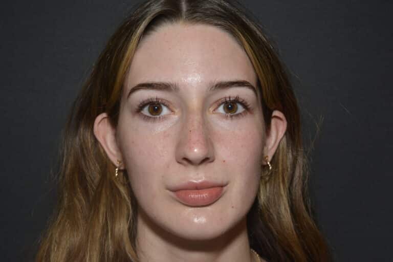 After Image: FIller to Nose – Liquid rhinoplasty - 