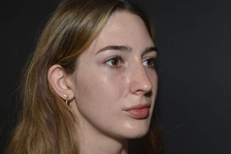 After Image: FIller to Nose – Liquid rhinoplasty - 