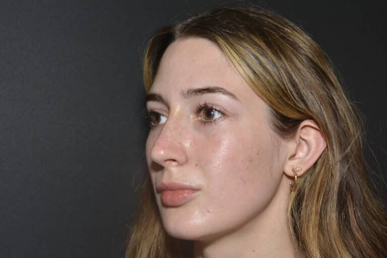 After Image: FIller to Nose – Liquid rhinoplasty - 