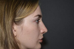 After Image: FIller to Nose – Liquid rhinoplasty
