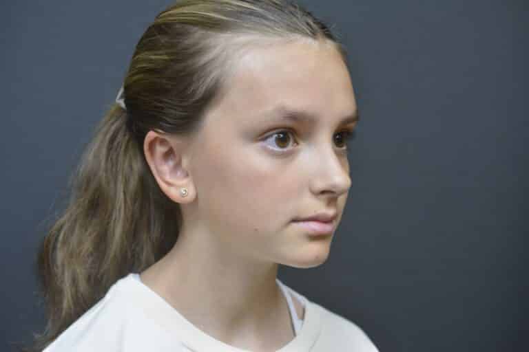 After Image: Otoplasty Ear reshaping - 