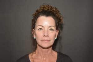 After Image: Naturale face neck lift
