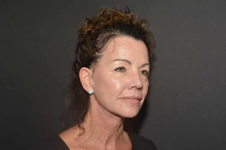 After Image: Naturale face neck lift - 