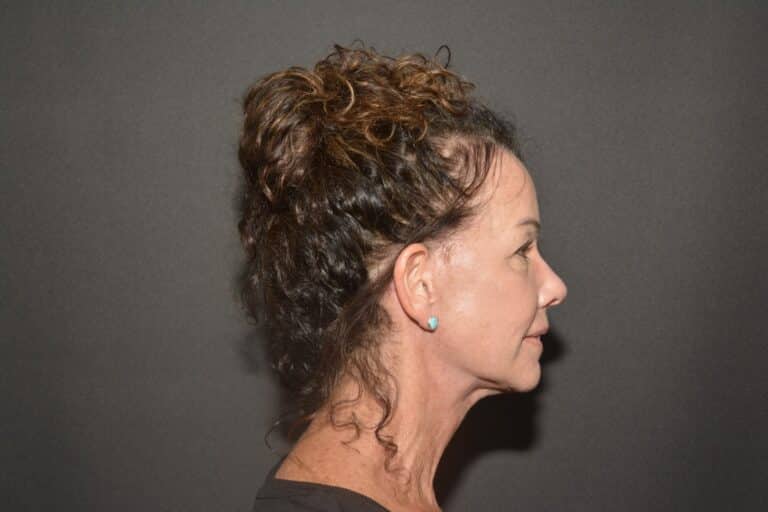 After Image: Naturale face neck lift - 