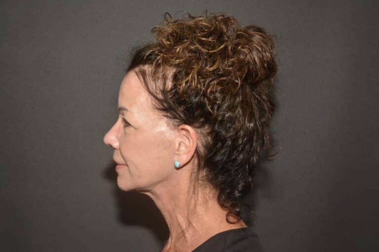 After Image: Naturale face neck lift - 