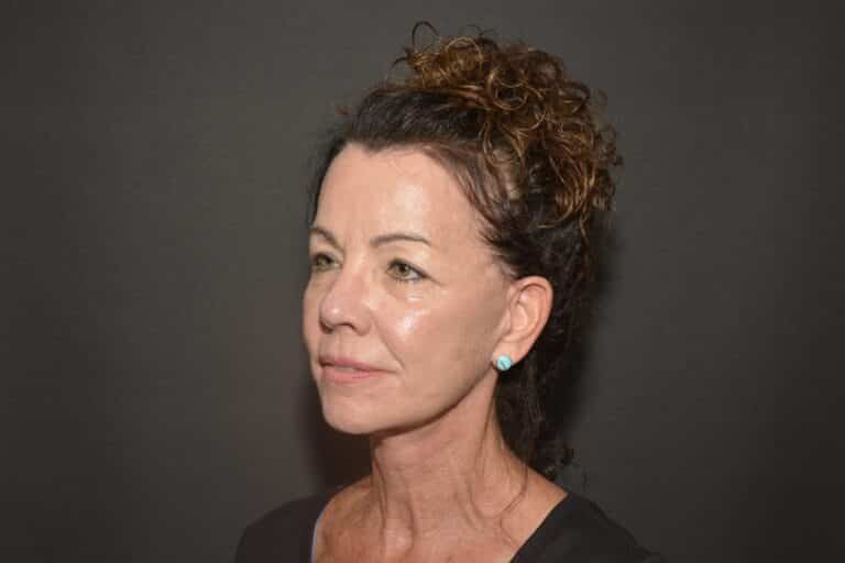 After Image: Naturale face neck lift - 