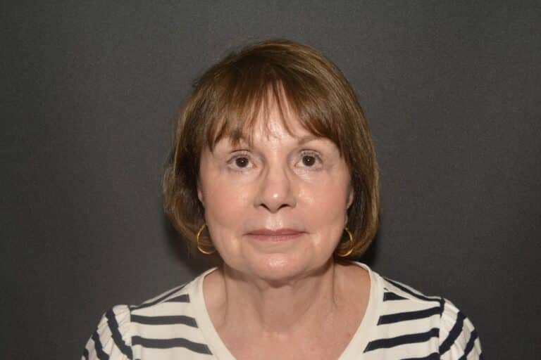 After Image: Lower eyelid surgery - front