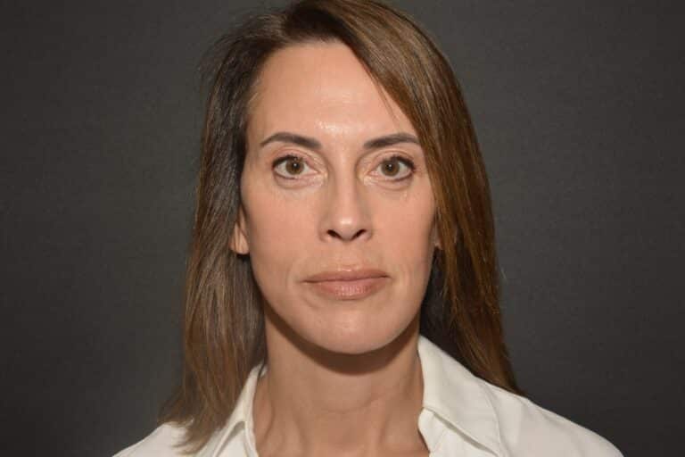 After Image: Naturale face neck lift - 