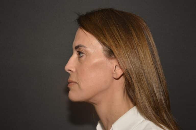 After Image: Naturale face neck lift - 