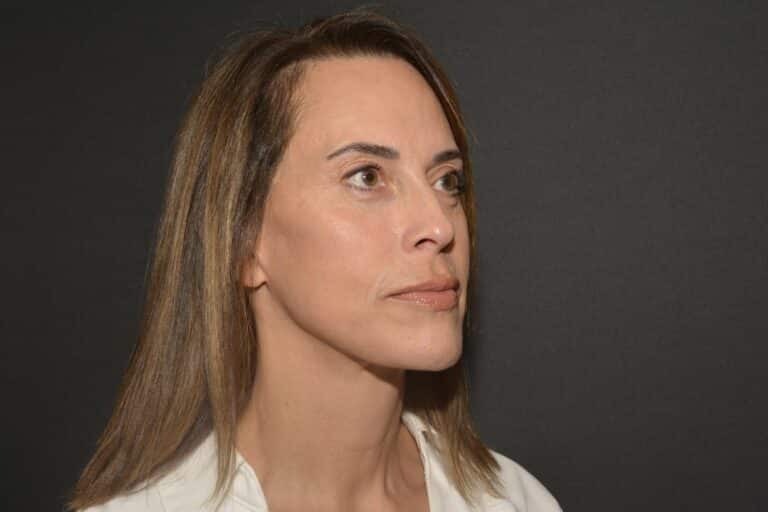 After Image: Naturale face neck lift - 