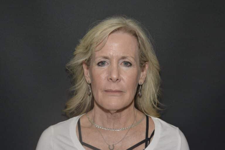 Before Image: Neck lift tonly - 