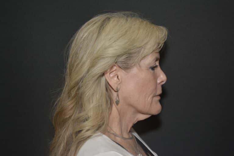 Before Image: Neck lift tonly - 