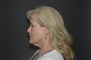 Before Image: Neck lift tonly