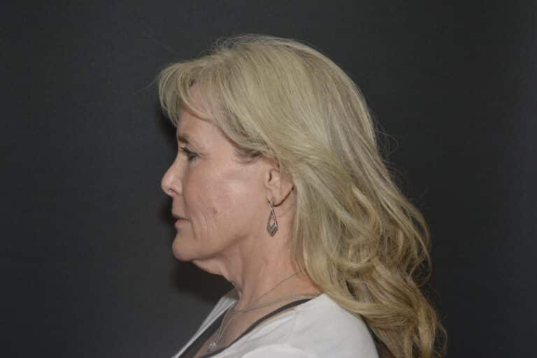 Before Image: Neck lift tonly - front