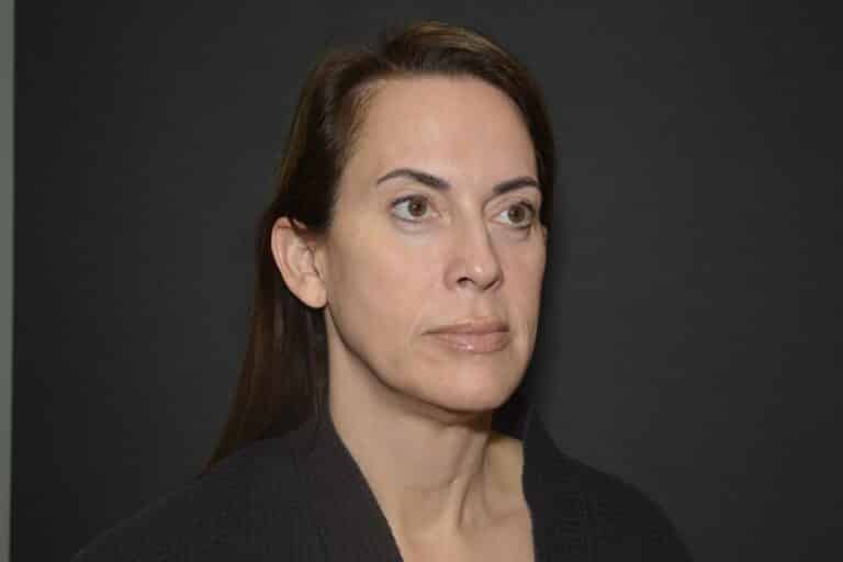 Before Image: Naturale face neck lift - 