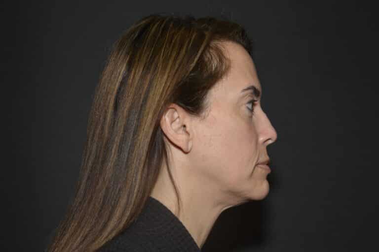 Before Image: Naturale face neck lift - 