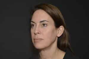 Before Image: Naturale face neck lift