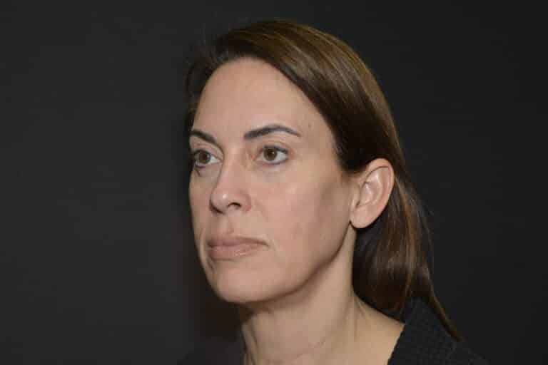 Before Image: Naturale face neck lift - front