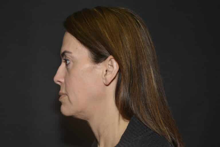 Before Image: Naturale face neck lift - 