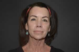 Before Image: Naturale face neck lift