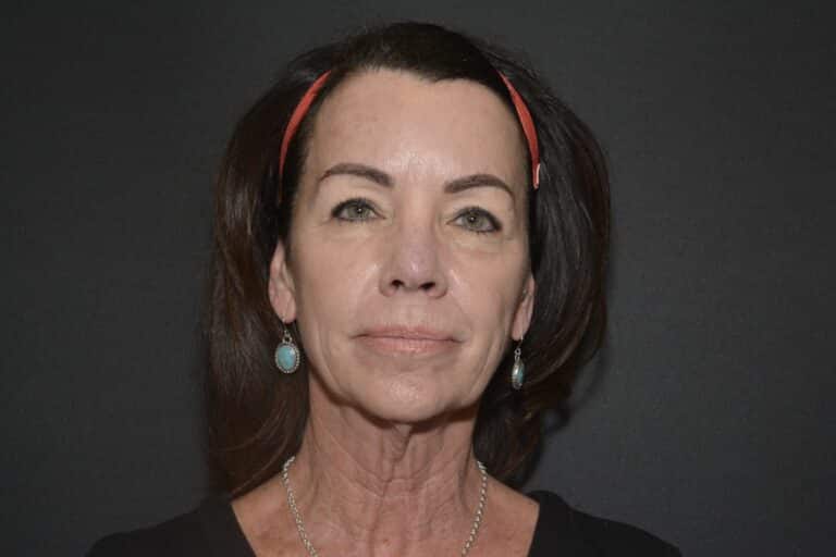Before Image: Naturale face neck lift - front