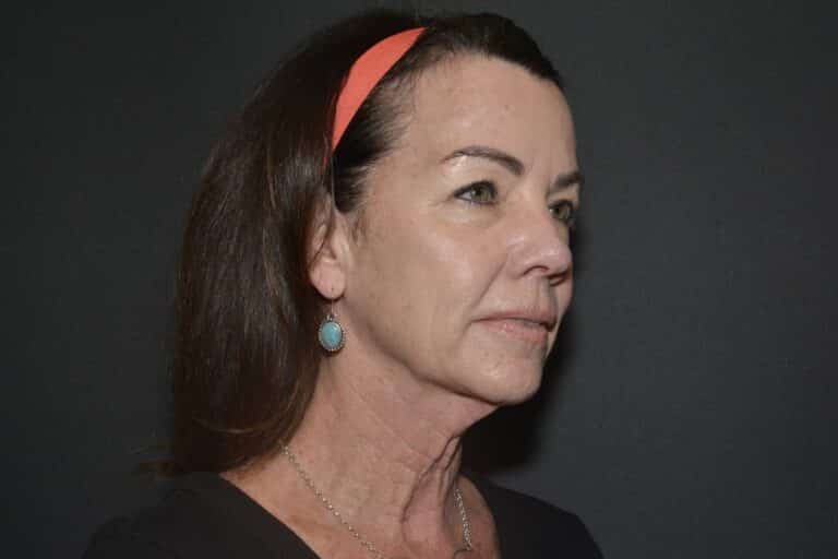 Before Image: Naturale face neck lift - 