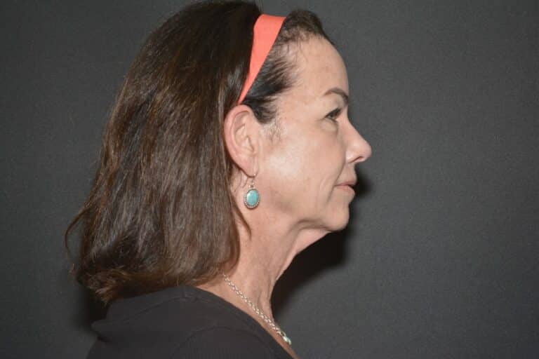 Before Image: Naturale face neck lift - 