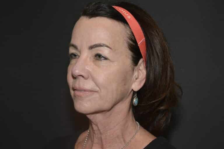 Before Image: Naturale face neck lift - 