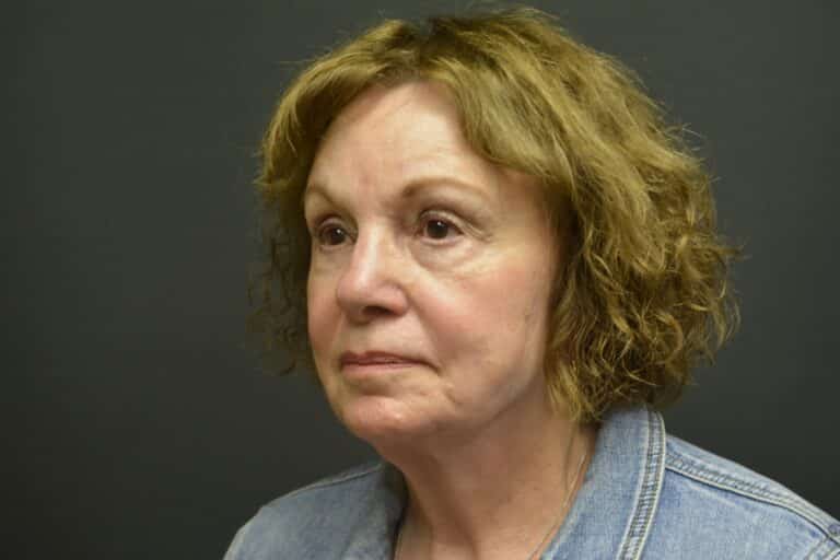 Before Image: Lower eyelid surgery - 