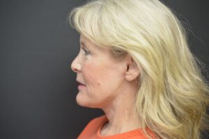 After Image: Neck lift tonly