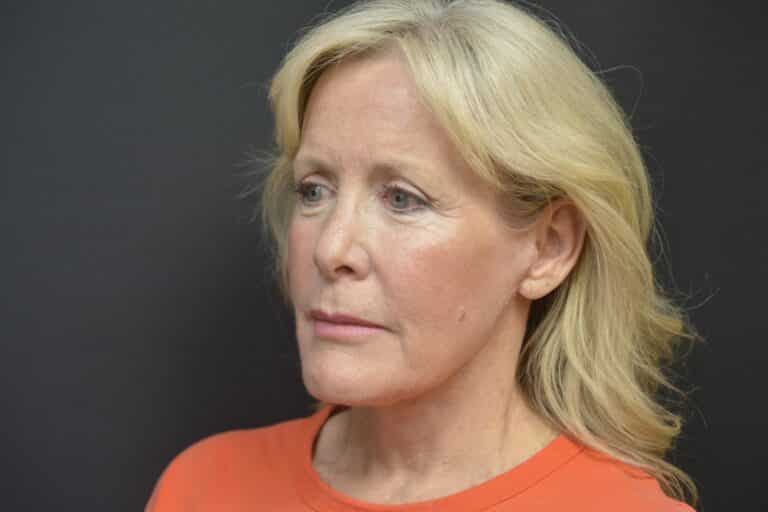 After Image: Neck lift tonly - 