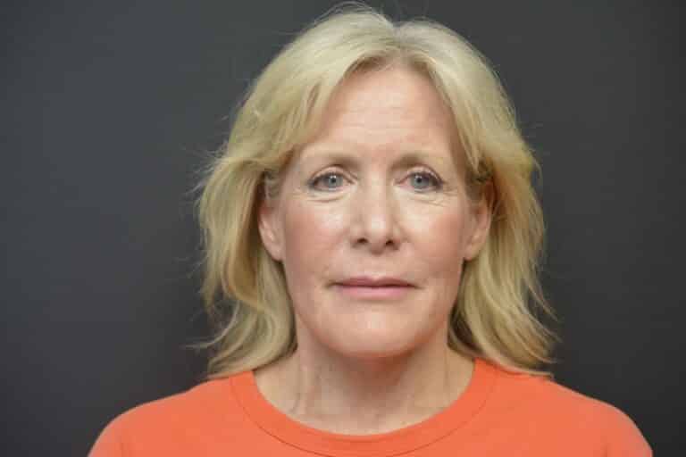 After Image: Neck lift tonly - 