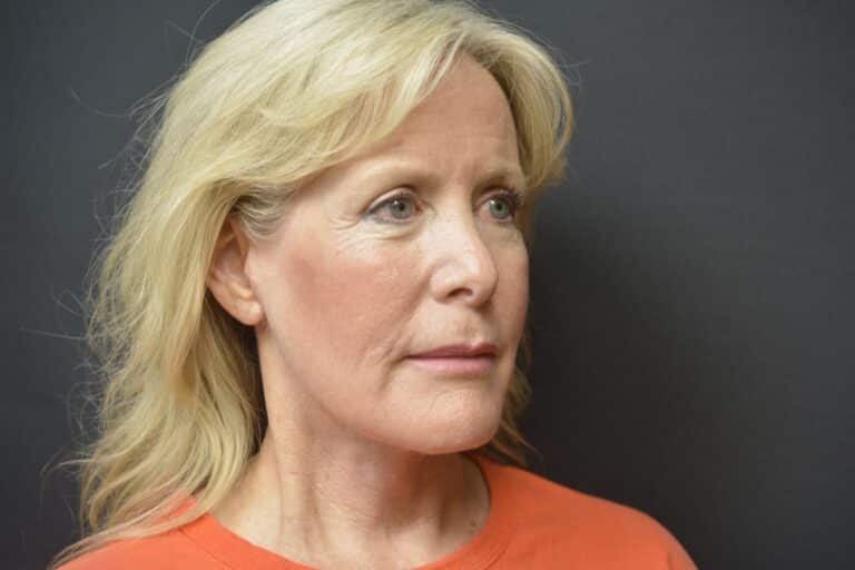 After Image: Neck lift tonly - 