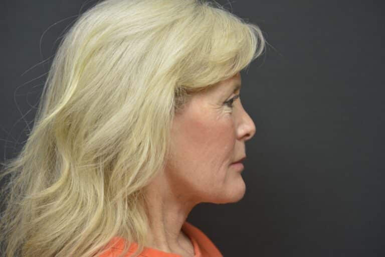 After Image: Neck lift tonly - 