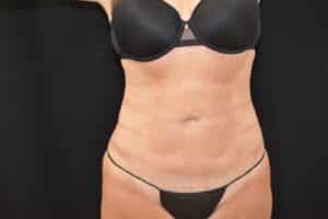 After Image: Liposuction 360