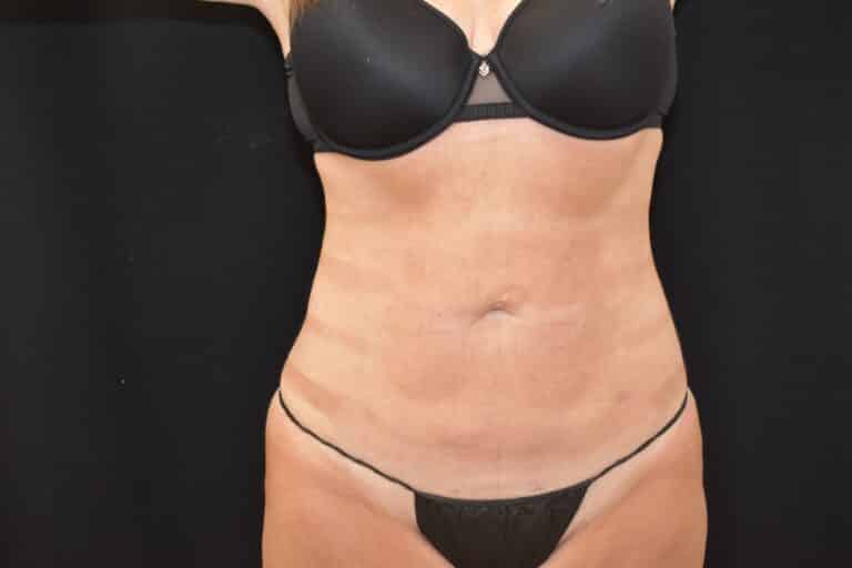 After Image: Liposuction 360 - front
