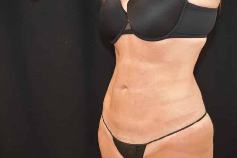 After Image: Liposuction 360 - 