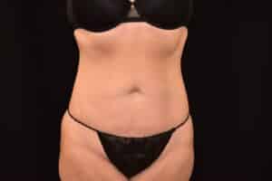 Before Image: Liposuction 360