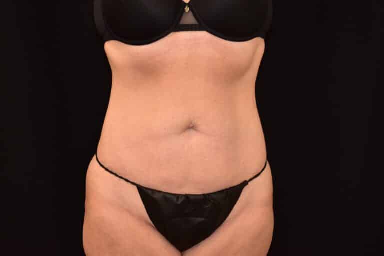 Before Image: Liposuction 360 - front