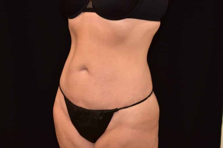 Before Image: Liposuction 360 - 