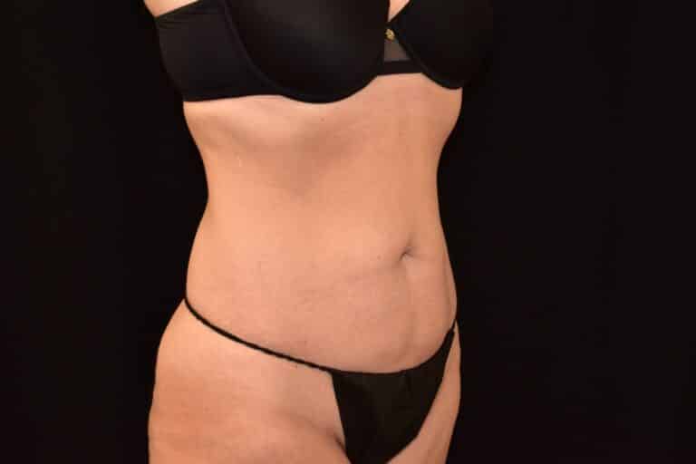 Before Image: Liposuction 360 - 