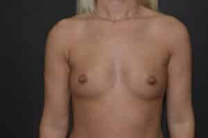 Before Image: Breast augmentation with silicone implants