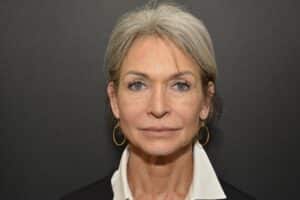 Before Image: Naturale face neck lift Deep plane and cervical platsymoplasty with Lip Lift under local anesthesia and oral sedation in office