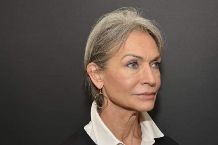 Before Image: Naturale face neck lift Deep plane and cervical platsymoplasty with Lip Lift under local anesthesia and oral sedation in office - front