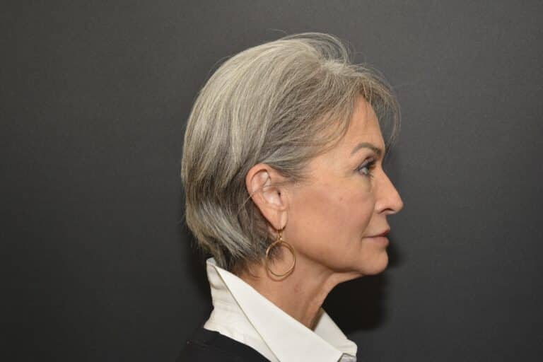 Before Image: Naturale face neck lift Deep plane and cervical platsymoplasty with Lip Lift under local anesthesia and oral sedation in office - front