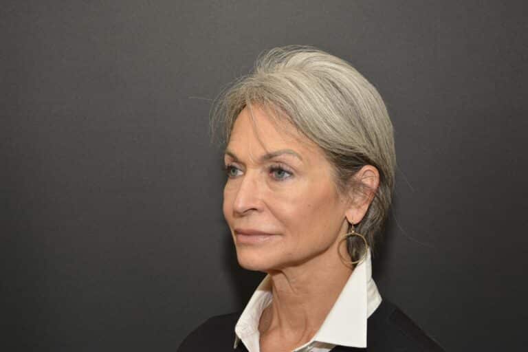 Before Image: Naturale face neck lift Deep plane and cervical platsymoplasty with Lip Lift under local anesthesia and oral sedation in office - front