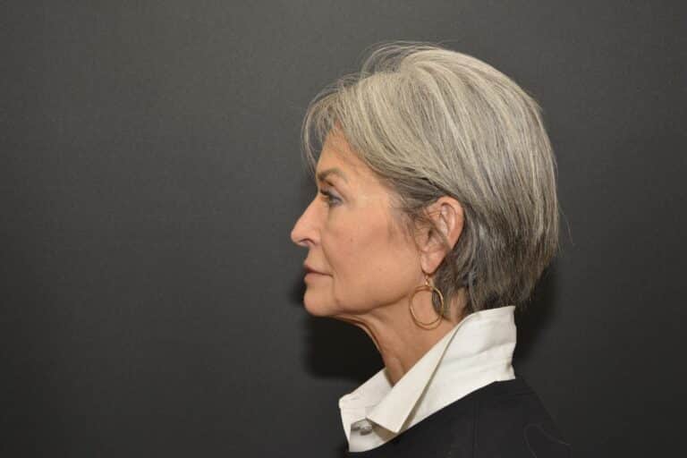Before Image: Naturale face neck lift Deep plane and cervical platsymoplasty with Lip Lift under local anesthesia and oral sedation in office - front