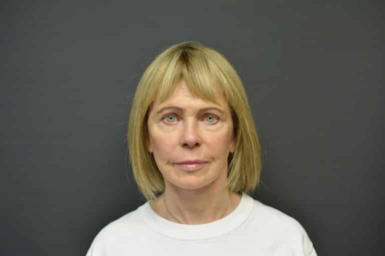 After Image: Naturale in office deep plane face-neck lift. In office under local anesthesia and oral sedation - front